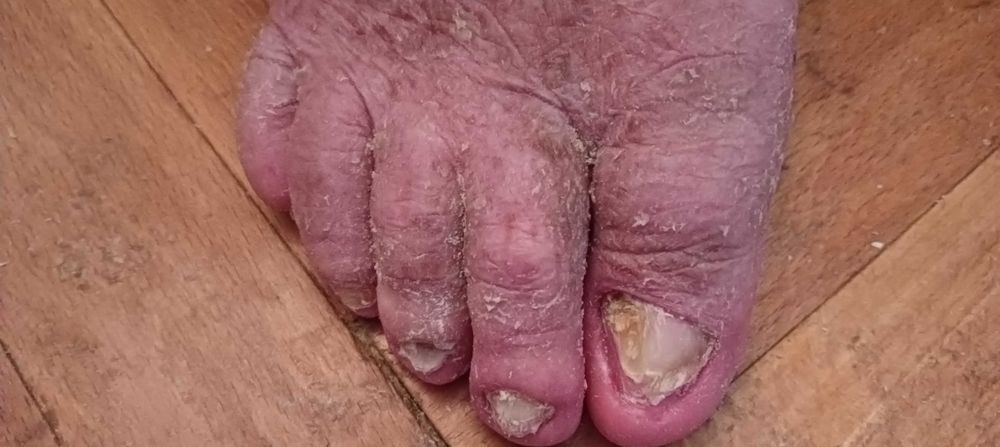 Pedichiura medicala fără durere