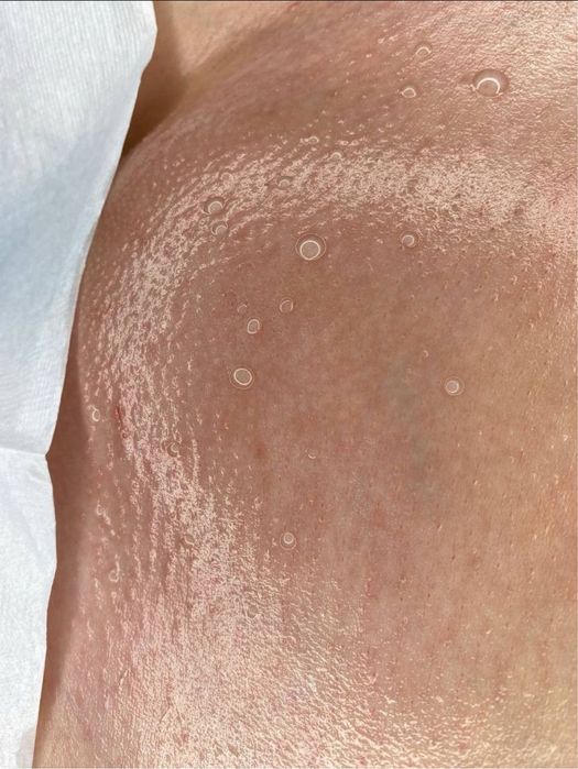 Шугаринг депиляция