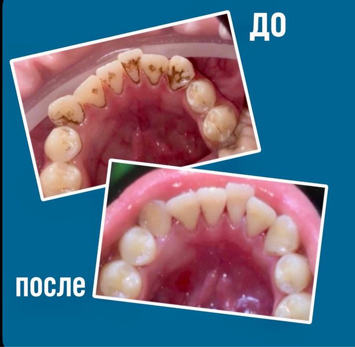 Проффессиональная чистка зубов