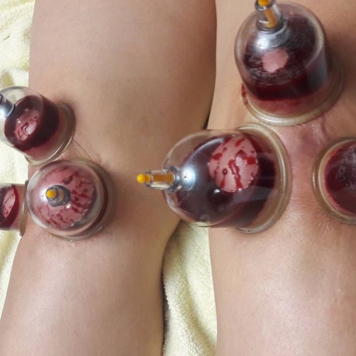 хиджама лечение по сунне.