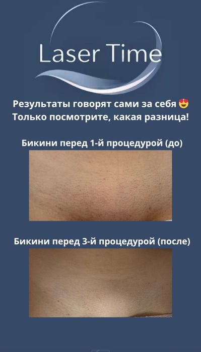 Лазерная эпиляция