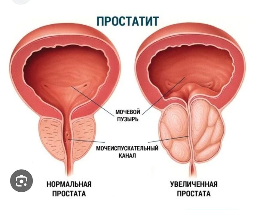 Емдік массаж. Простата массаж.