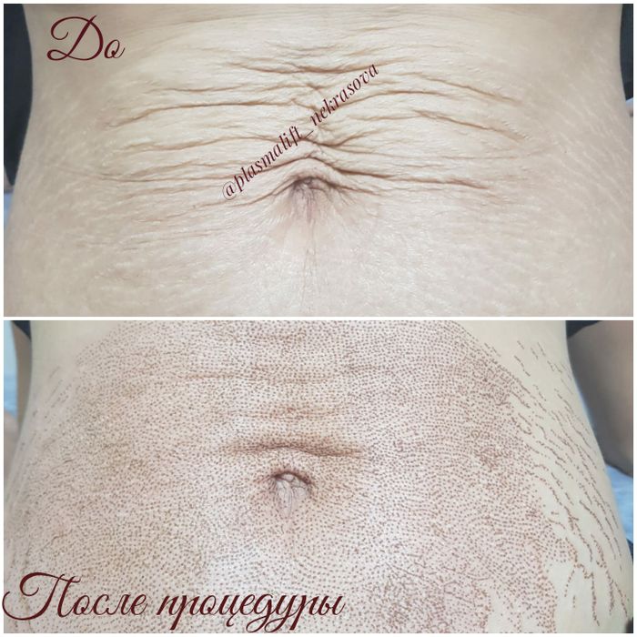 Продам плазмапен BEAUTY MONSTER и GZEL