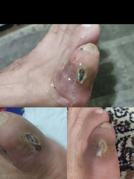 Ичига усган тирнок,Подолог хизмати