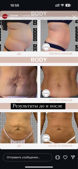 Аппарат для массажа Icoone Laser