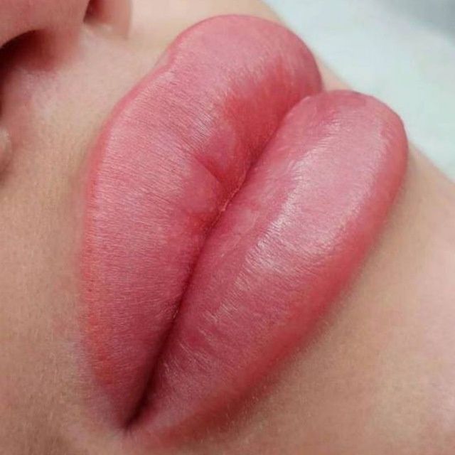 Ботокс,Губы в Ташкенте