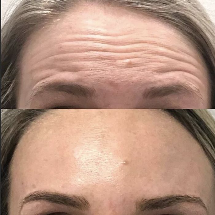 Ботокс мезаботокс фуллфейс