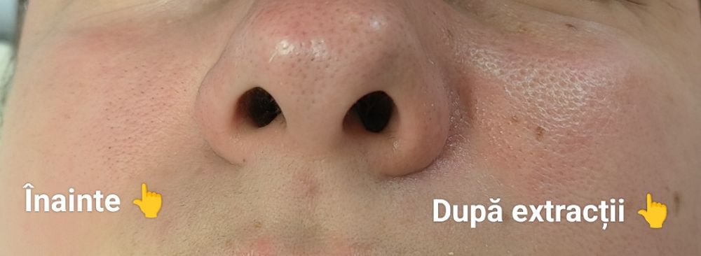 Epilare definitiva cu 4 lungimi de undă, cu ceara și tratamente