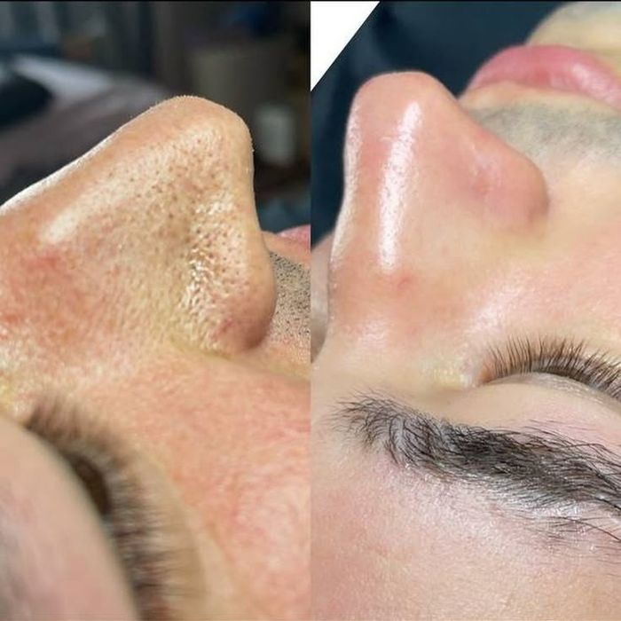 Шугаринг чистка лица мужская