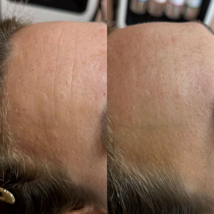 Cosmetolga chistka piling Erkeylar va ayollar uchun