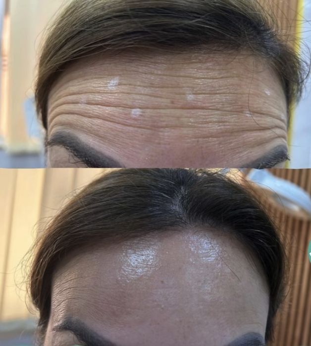 Botoks, fulface, ajinlarni yùqotish. Ботокс  ,Фулфейс, Траптокс,