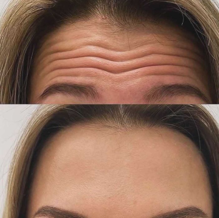 Акция на косметологические процедуры. Скидки до 50%