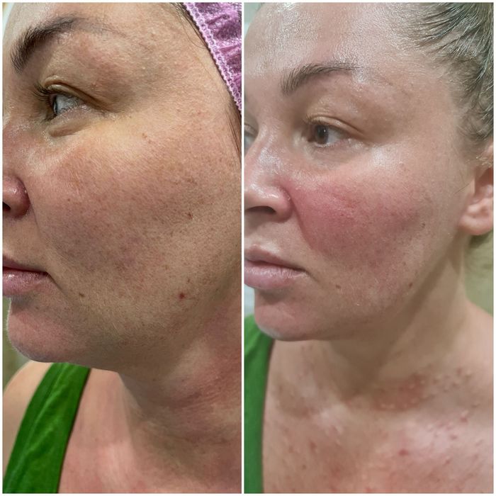 Косметологические услуги (мужчины и женщины) ,фуллфейз ботокс, губы