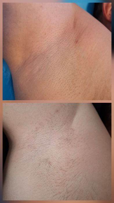 Epilare progresiv definitiva laser dioda