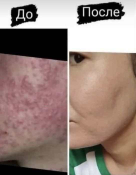 Ультрафонофорез аппарат