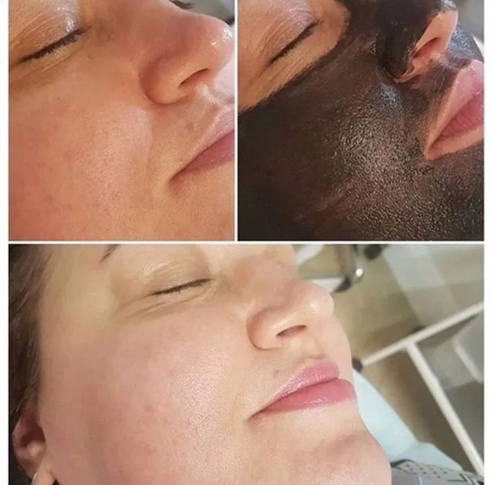 Карбоновый пилинг,7000  омоложение