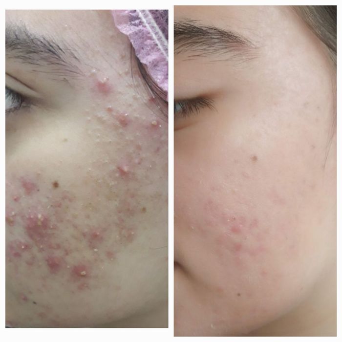 Врач косметолог. Ташкент. Атравматичная, комплексная чистка лица