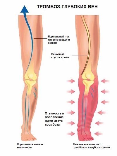 УЗИ (Уздг) сосудов