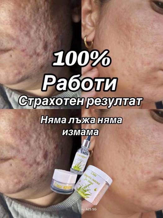 Еми крем за акне пъпки избелване и пигментация