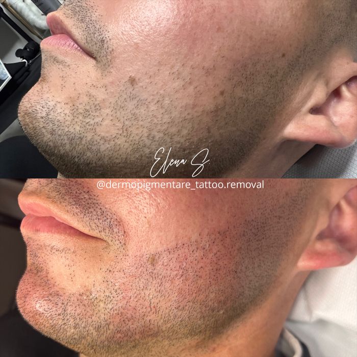 Micropigmentare barba scalp sprancene barbati Bucuresti