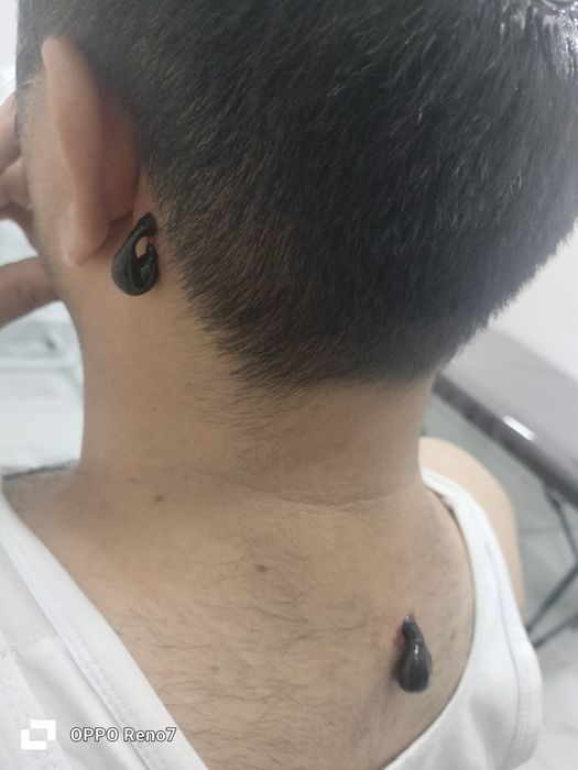 тиббий зулуклар гирудотерапия