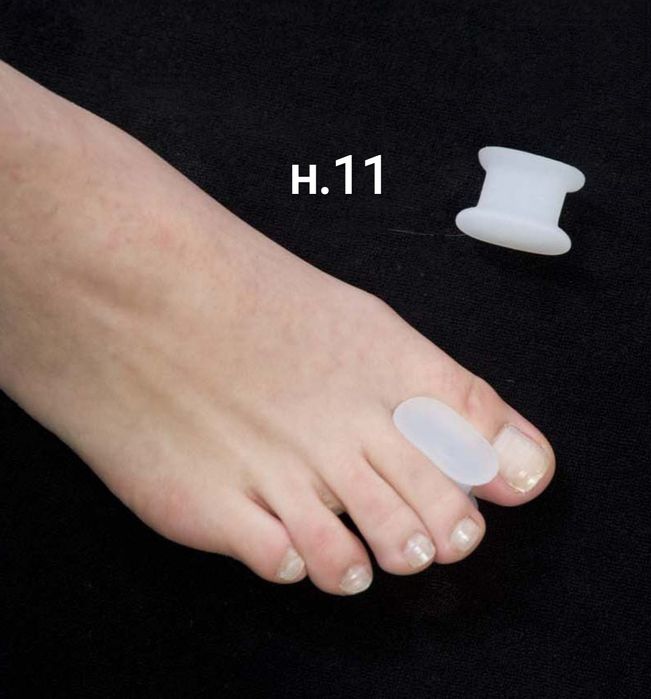 Изпъкнали кокалчета ”hallux valgus”-различни видове