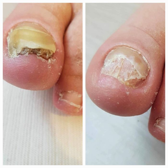 Pedichiura curativa