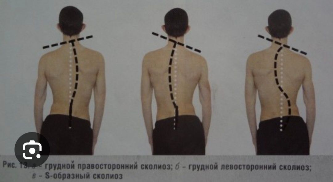 Сколиоз грудного отдела. Левосторонний сколиоз грудного отдела степени. S образный грудопоясничный сколиоз. S образный грудопоясничный сколиоз 2 степени массаж. S образный сколиоз 1 степени грудного отдела.