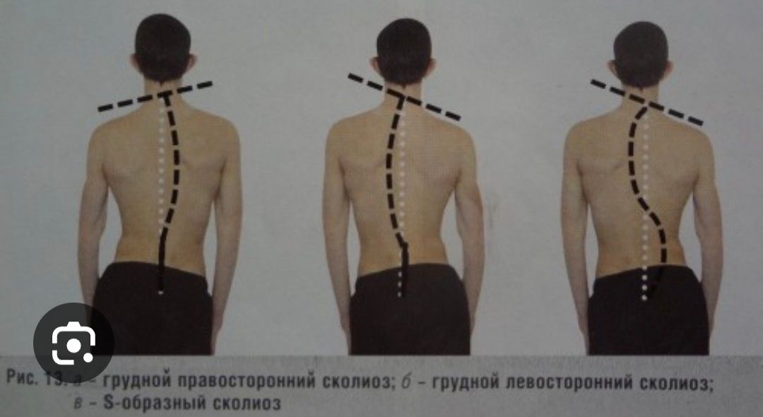 Позвоночника 2 степени. Левосторонний сколиоз грудного отдела степени. S образный грудопоясничный сколиоз. S образный грудопоясничный сколиоз 2 степени массаж. S образный сколиоз 1 степени грудного отдела.