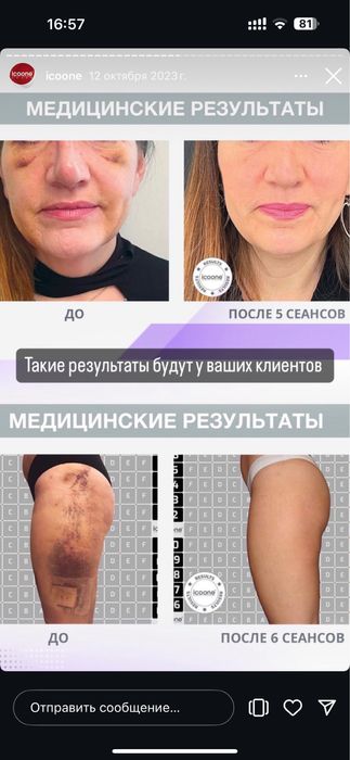 Аппарат для массажа Icoone Laser