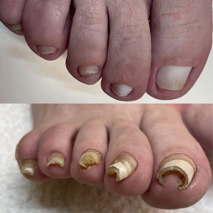 Pedichiură Medicală