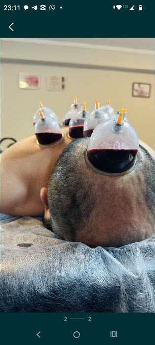 Хиджама профессиональный