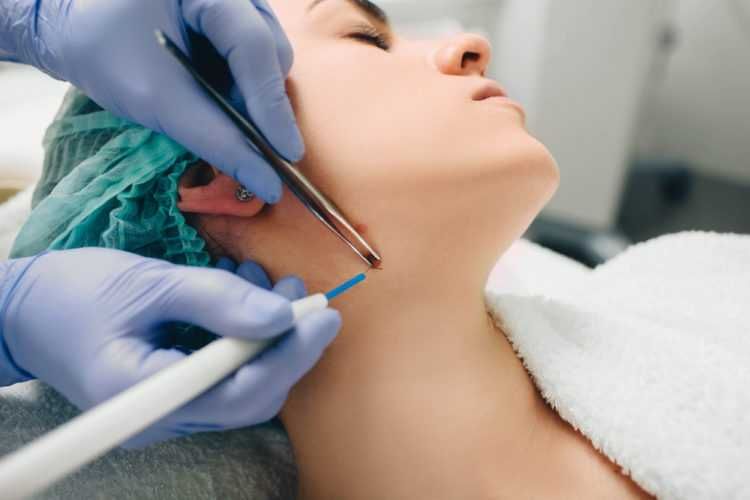 Удаление папиллом, электрокоагуляция и лазер. Papilloma yo'qotish.