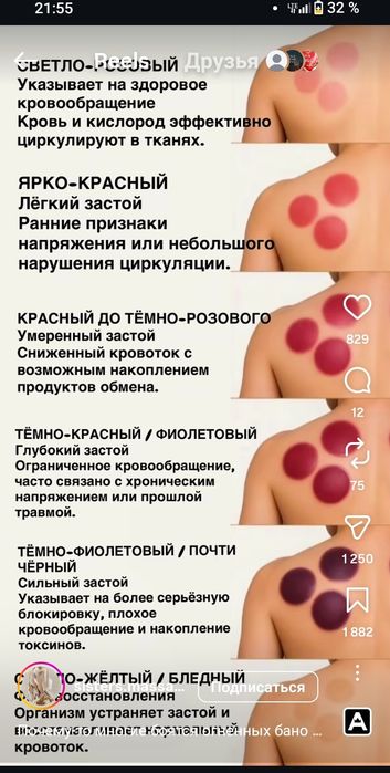 ХИДЖАМА массаж лечение пиявками