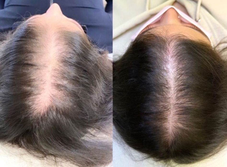 Трихопигментация волос