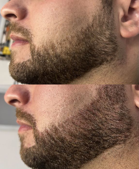 Micropigmentare barba scalp sprancene barbati Bucuresti