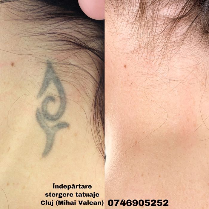 Tatuaj cosmetic , Microblading si Eliminare Tatuaje cu Laser