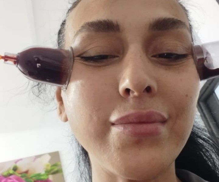 Хиджама профессионально. Банки есть!