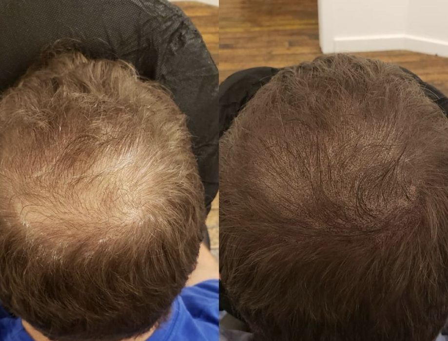 Minoxidil original pentru cresterea părului