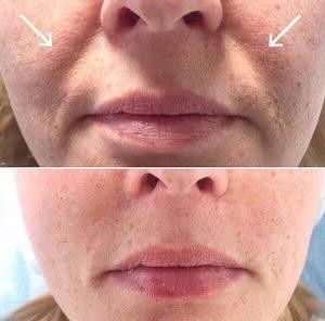 Супер акция 800тыс Носогубные складки