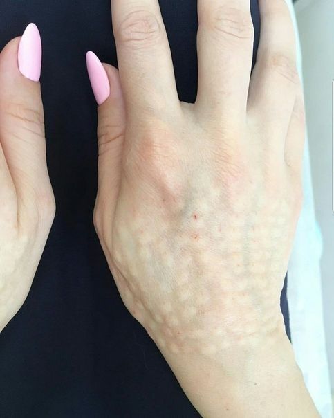 Биоревитализация рук