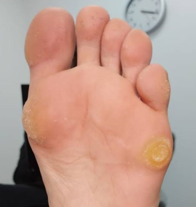 Квалифицированная помощь подолога.