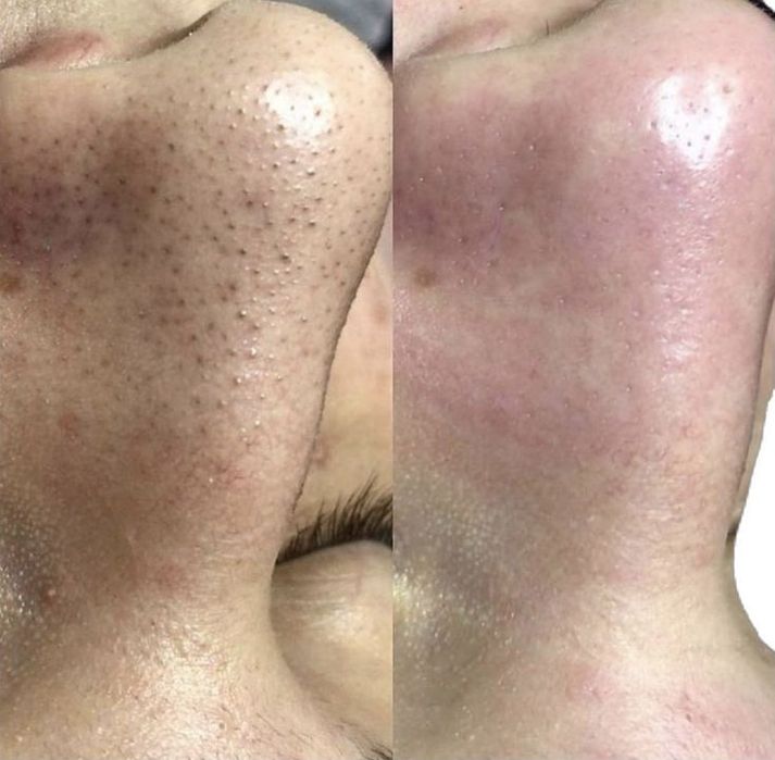 Врач Дерматолог-Косметолог |Чистка лица | Профессиональные процедуры