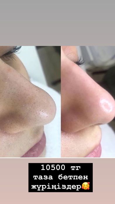 Чистка лица с результатом с первой процедуры