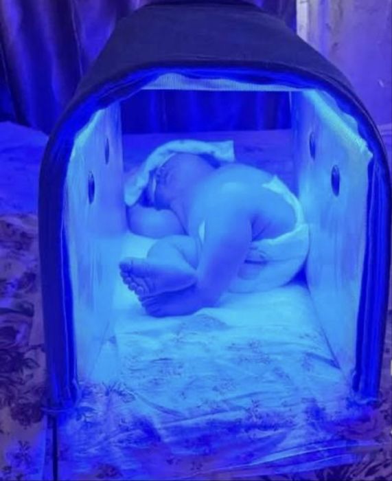 фотолампа (фототерапия)  детям- bolalarga fotolampa (fototerapiya)