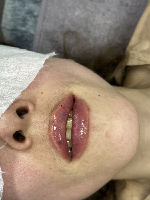 Аугментация губ,Чистка лица,БРВ,Мезотерапия