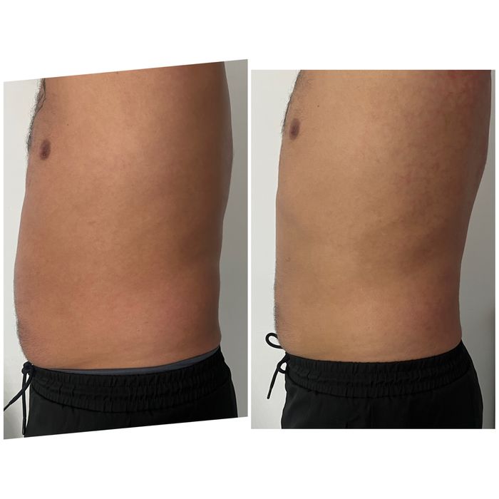 Ультраформер, косметологический аппарат