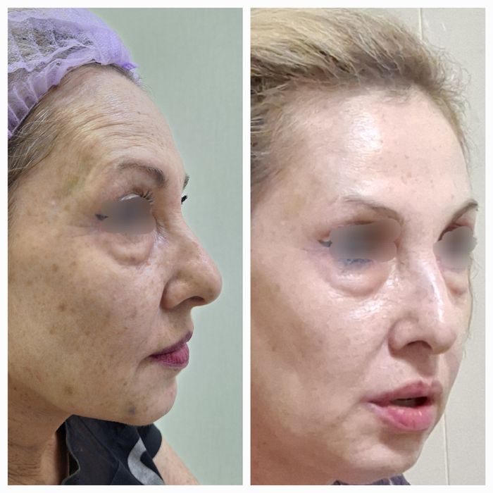 Ботулинотерапия. Лечение морщин ( ботокс)