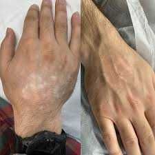 Vitiligo kamuflyaji