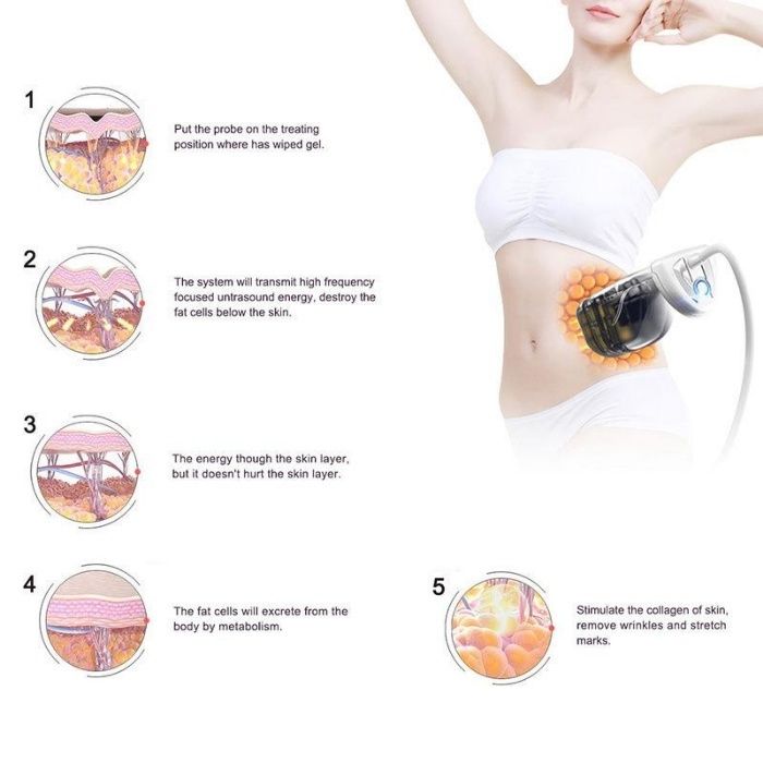 Liposonix. Безоперационная липосакция!